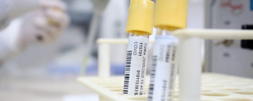Jaraguá do Sul adquire mais 2 mil testes rápidos para o novo coronavírus Jaraguá do Sul adquire mais 2 mil testes rápidos para o novo coronavírus