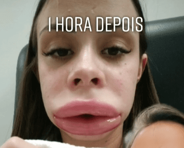Jovem descobre doença rara após realizar preenchimento labial e ficar inchada; veja