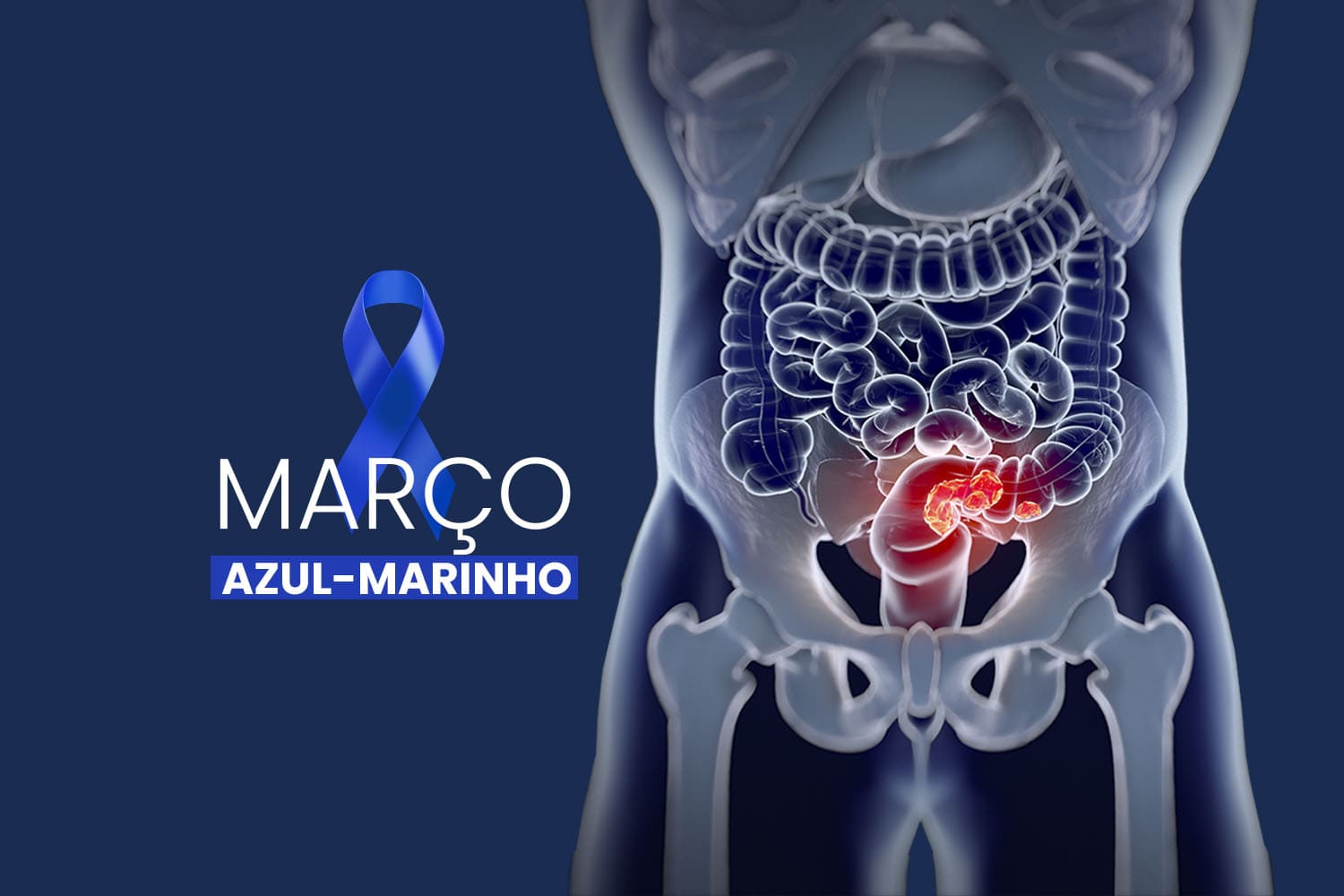 Março Azul: campanha busca conscientizar população sobre câncer de intestino