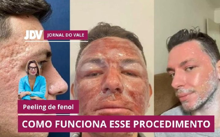 Vídeo – Compreenda os cuidados para realização do Peeling de Fenol