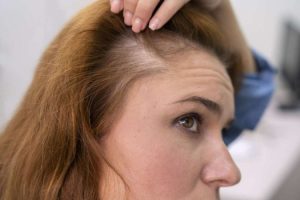 Novo remédio contra queda de cabelo é aprovado pela Anvisa: baricitinibe é usado contra artrite, dermatite e Covid