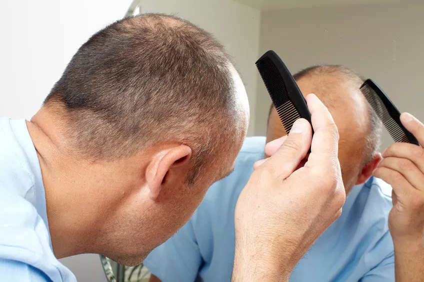 Novo remédio contra queda de cabelo é aprovado pela Anvisa: baricitinibe é usado contra artrite, dermatite e Covid