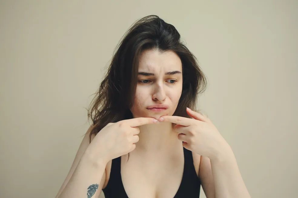 Acne em diferentes fases da vida: entenda como a doença afeta bebês, adolescentes e adultos