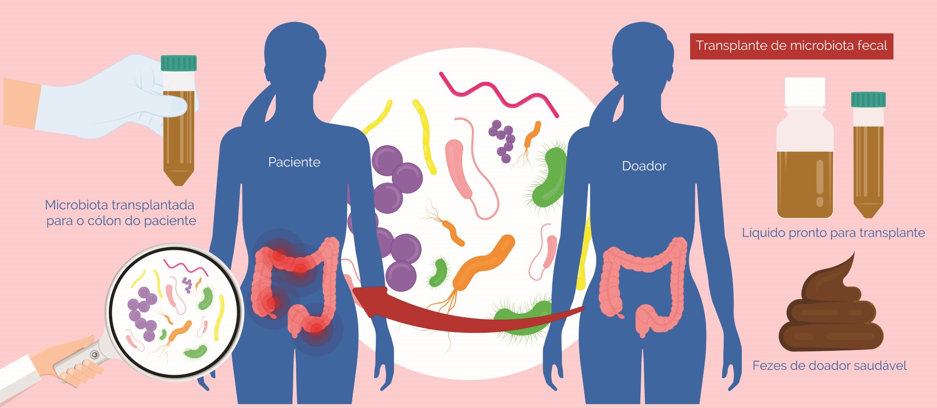 Transplante de fezes avança no SUS como opção de tratamento para infecções resistentes a antibióticos