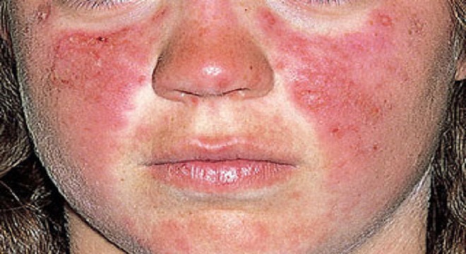 Palestra em Jaraguá busca esclarecer sobre o lúpus e como conviver com a doença